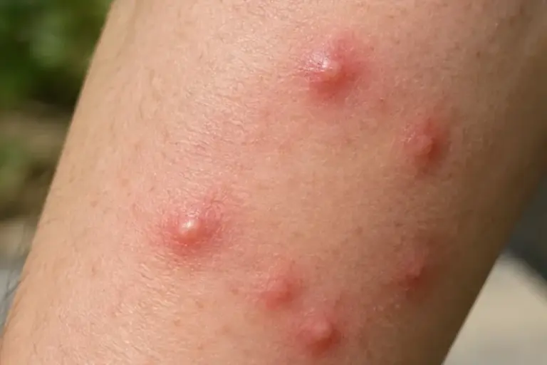 What To Do Right After Fire Ants Sting You In Your North Carolina Yard, And Why Those White Pustules Should Stay Unpopped